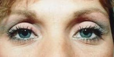 Blepharoplasty Before & After Gallery - Patient 704976 - Image 2