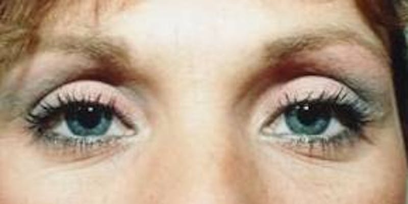 Blepharoplasty Before & After Gallery - Patient 704976 - Image 2