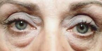 Blepharoplasty Before & After Gallery - Patient 336742 - Image 1