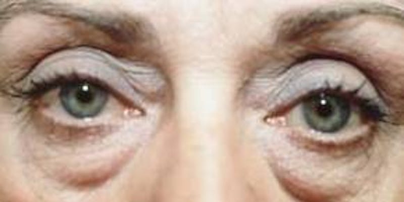 Blepharoplasty Before & After Gallery - Patient 336742 - Image 1