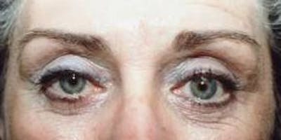Blepharoplasty Before & After Gallery - Patient 336742 - Image 2