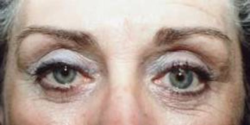 Blepharoplasty Before & After Gallery - Patient 336742 - Image 2
