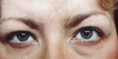 Blepharoplasty Before & After Gallery - Patient 296520 - Image 1