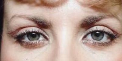 Blepharoplasty Before & After Gallery - Patient 296520 - Image 2