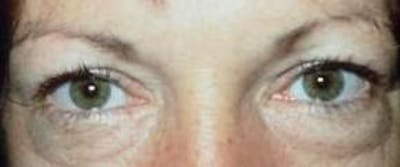 Blepharoplasty Before & After Gallery - Patient 234953 - Image 1