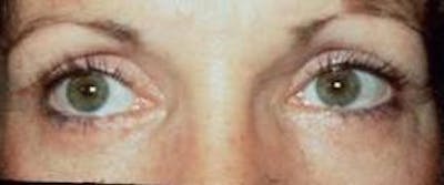 Blepharoplasty Before & After Gallery - Patient 234953 - Image 2