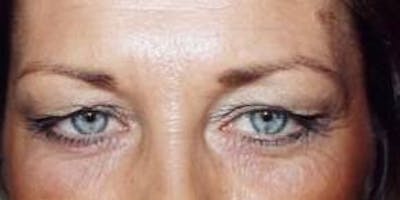 Blepharoplasty Before & After Gallery - Patient 222467 - Image 1