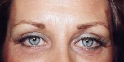 Blepharoplasty Before & After Gallery - Patient 222467 - Image 2