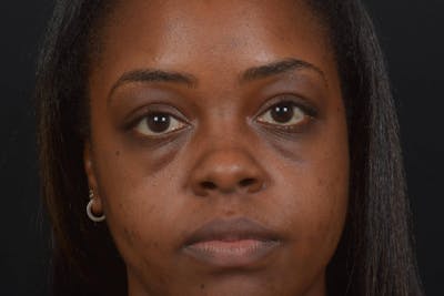 Blepharoplasty Before & After Gallery - Patient 183952 - Image 1