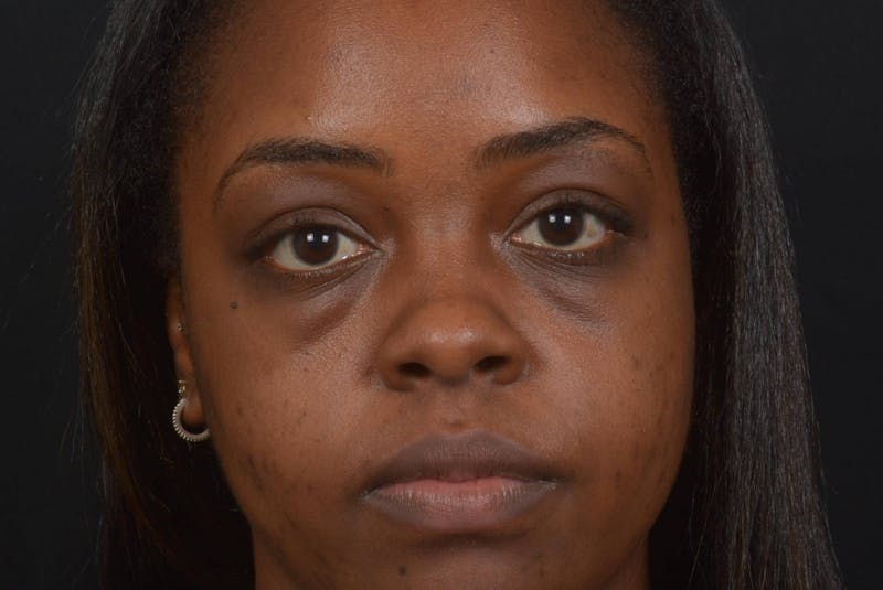 Blepharoplasty Before & After Gallery - Patient 183952 - Image 1