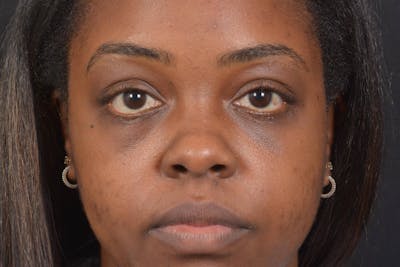 Blepharoplasty Before & After Gallery - Patient 183952 - Image 2