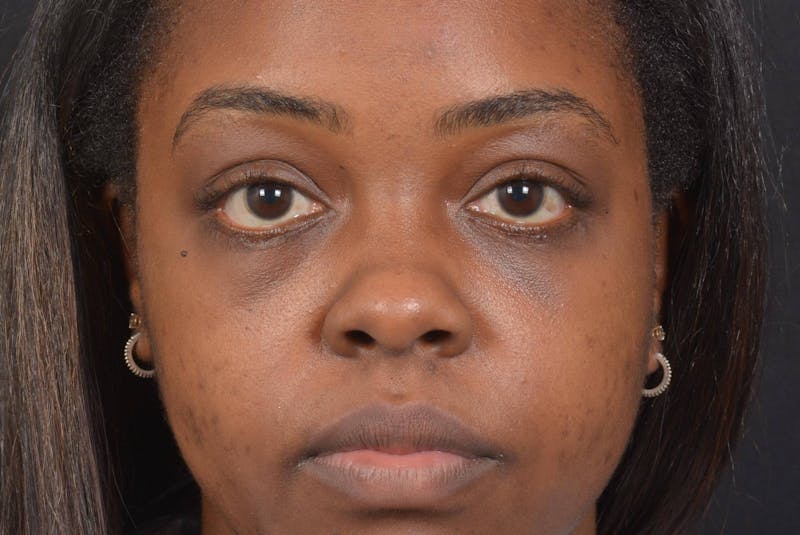 Blepharoplasty Before & After Gallery - Patient 183952 - Image 2
