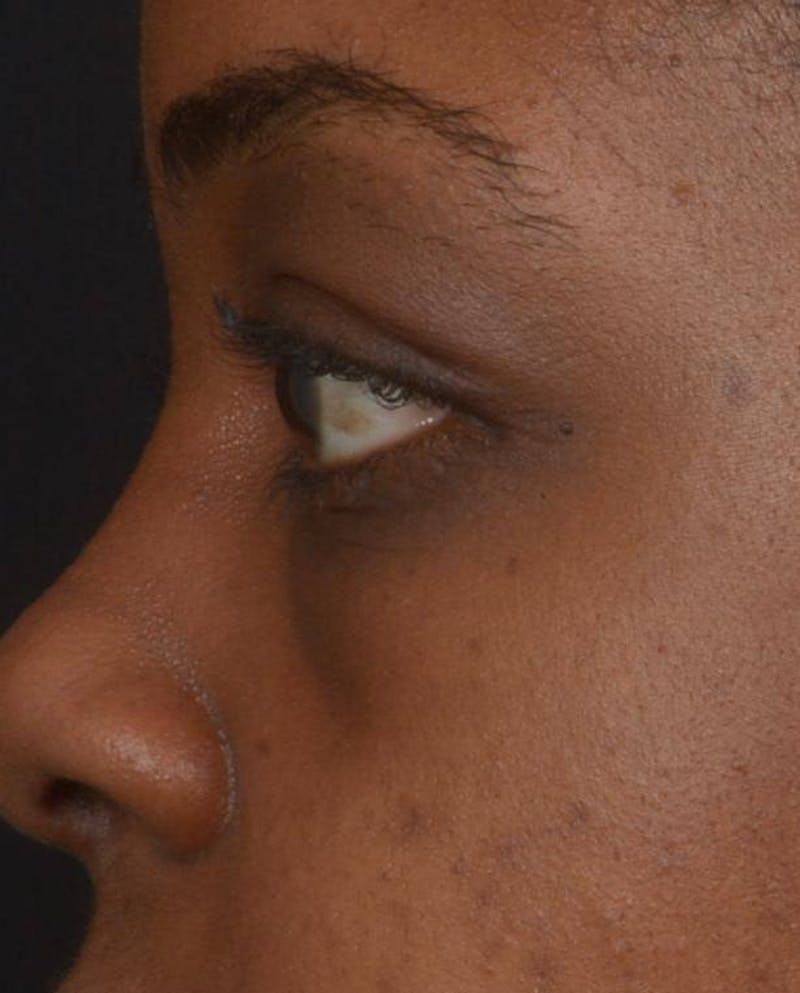 Blepharoplasty Before & After Gallery - Patient 183952 - Image 3