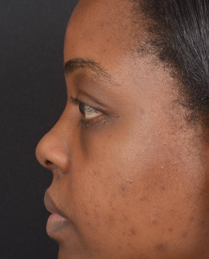 Blepharoplasty Before & After Gallery - Patient 183952 - Image 4