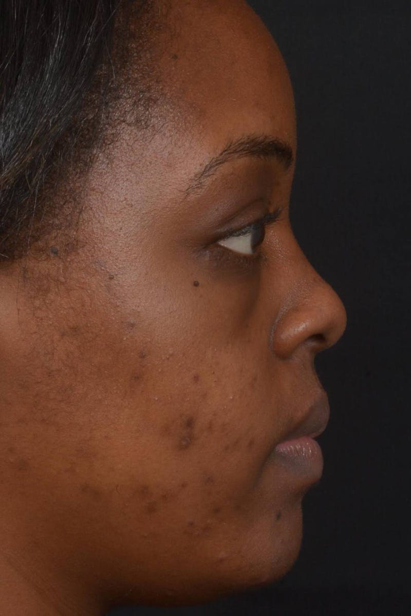 Blepharoplasty Before & After Gallery - Patient 183952 - Image 5