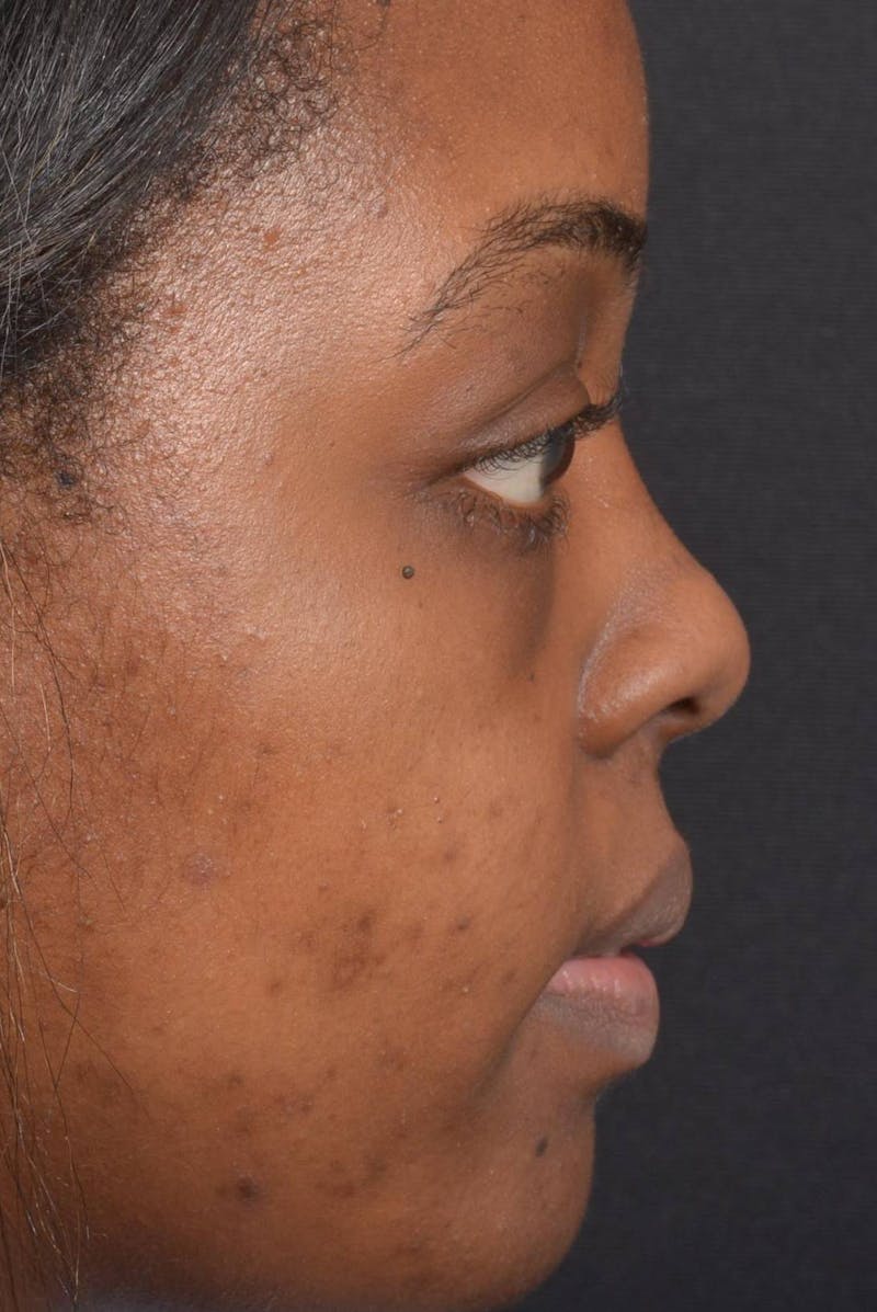 Blepharoplasty Before & After Gallery - Patient 183952 - Image 6