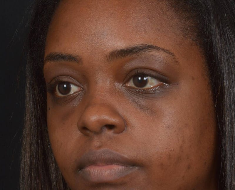 Blepharoplasty Before & After Gallery - Patient 183952 - Image 7