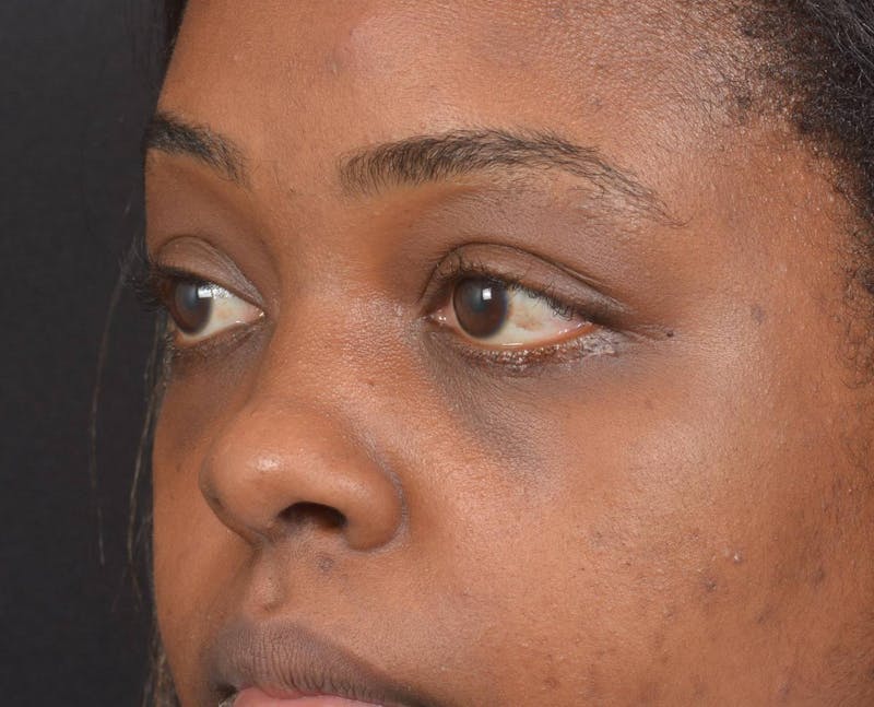 Blepharoplasty Before & After Gallery - Patient 183952 - Image 8
