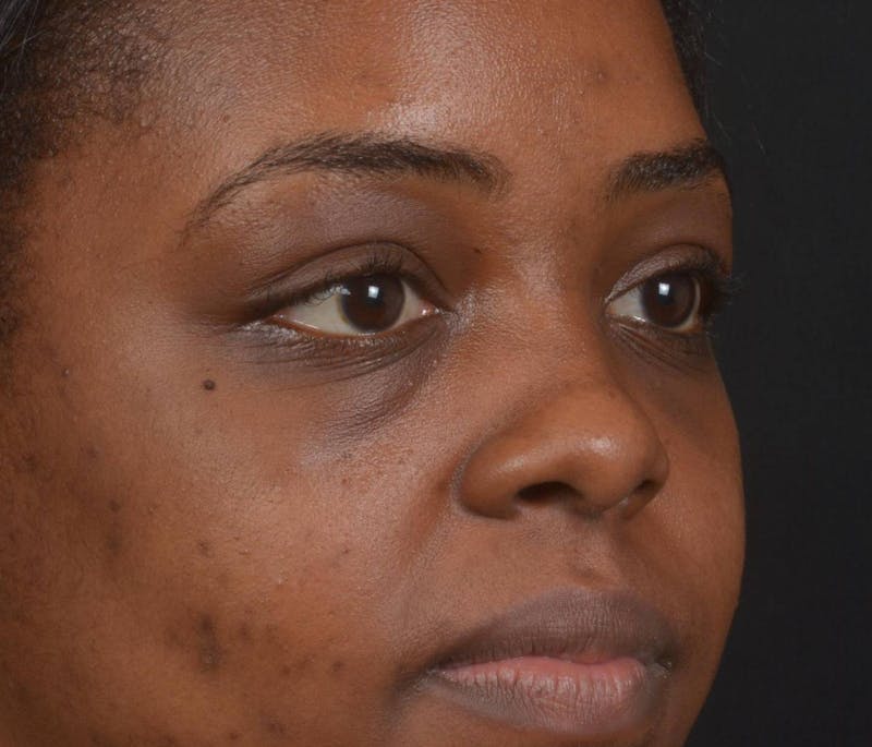 Blepharoplasty Before & After Gallery - Patient 183952 - Image 9