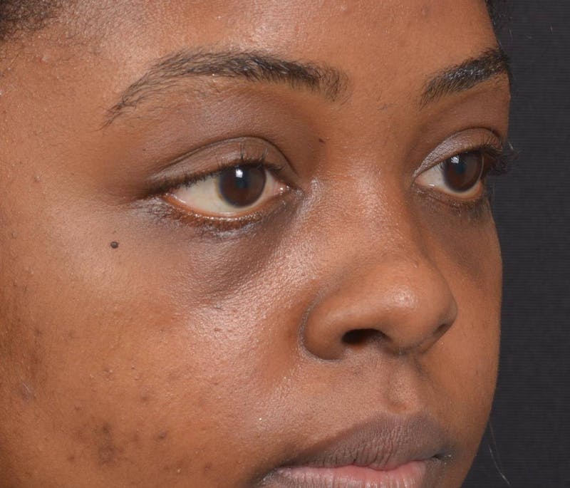 Blepharoplasty Before & After Gallery - Patient 183952 - Image 10