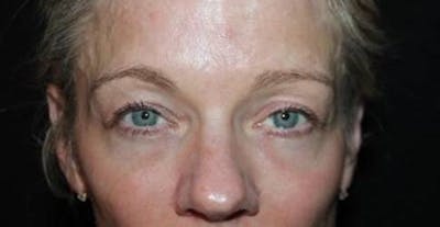 Blepharoplasty Before & After Gallery - Patient 313792 - Image 1