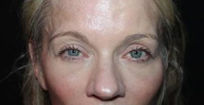 Blepharoplasty Before & After Gallery - Patient 313792 - Image 2