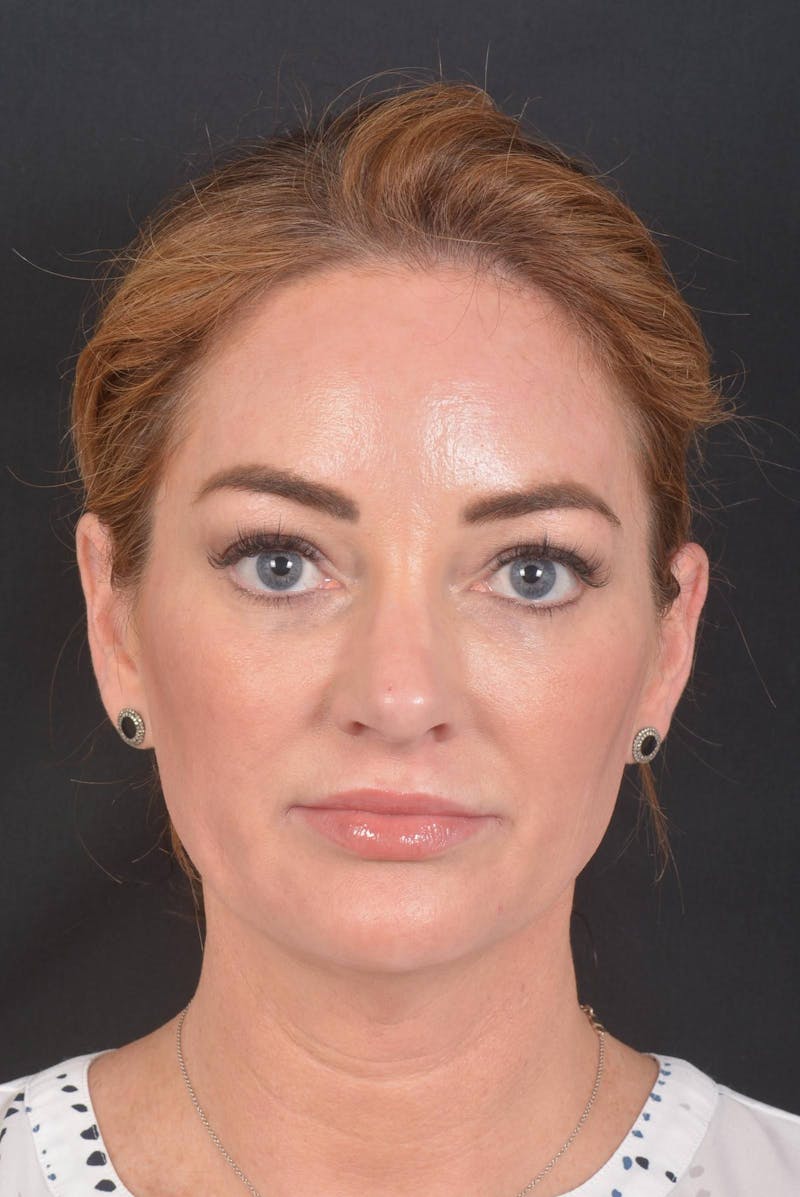 Facelift Before & After Gallery - Patient 418461 - Image 1