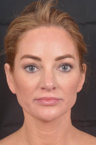 Facelift Before & After Gallery - Patient 418461 - Image 2