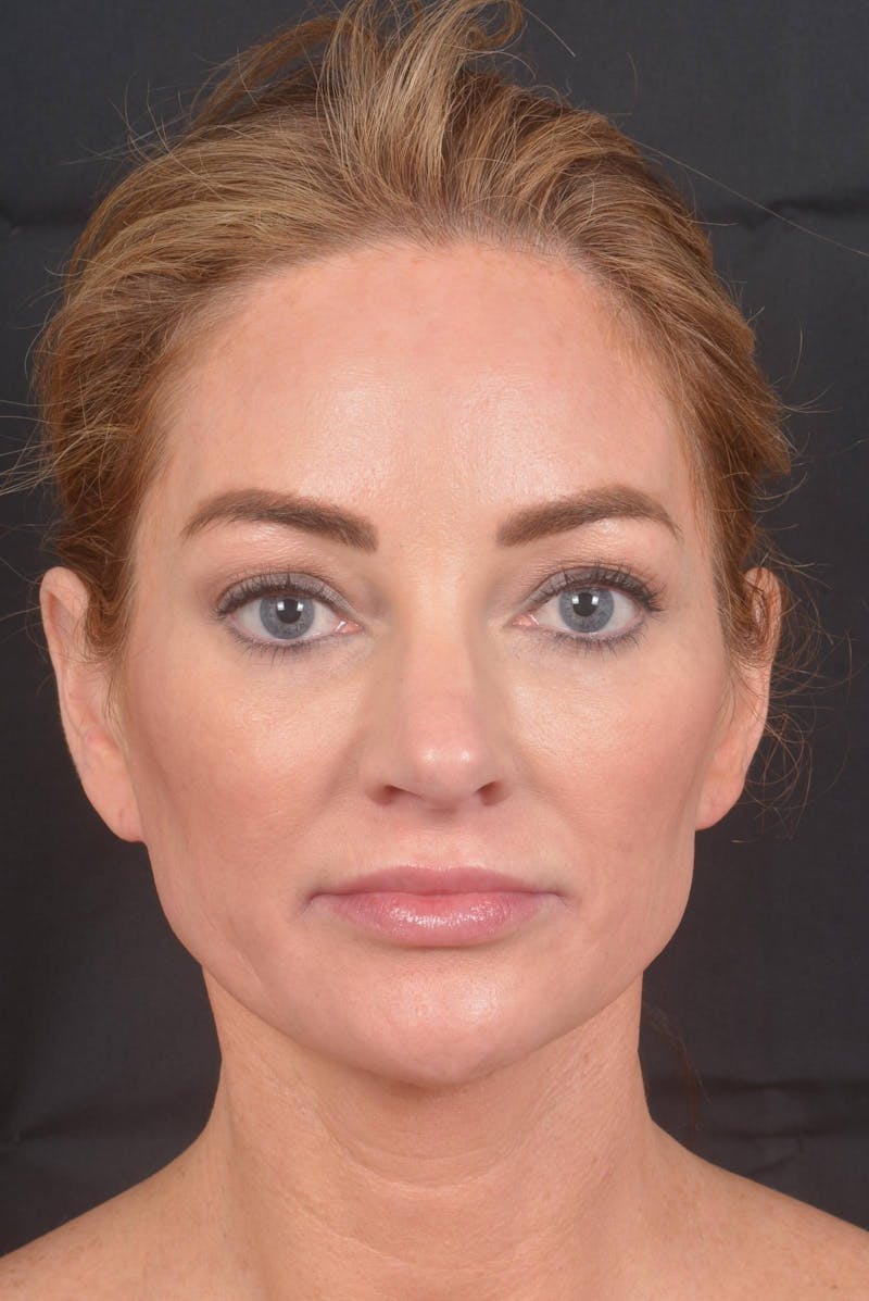 Facelift Before & After Gallery - Patient 418461 - Image 2