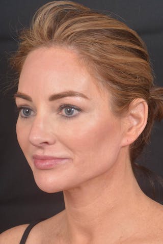 Facelift Before & After Gallery - Patient 418461 - Image 8
