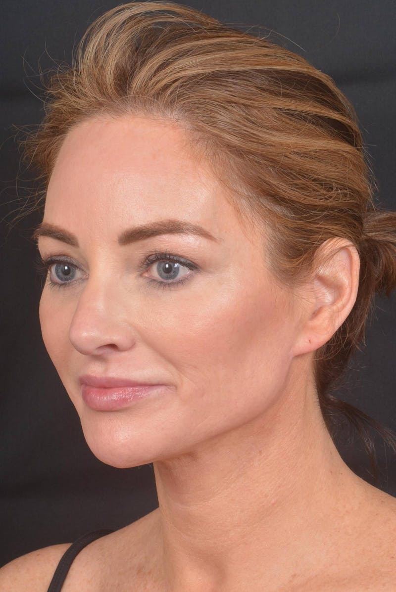Facelift Before & After Gallery - Patient 418461 - Image 8