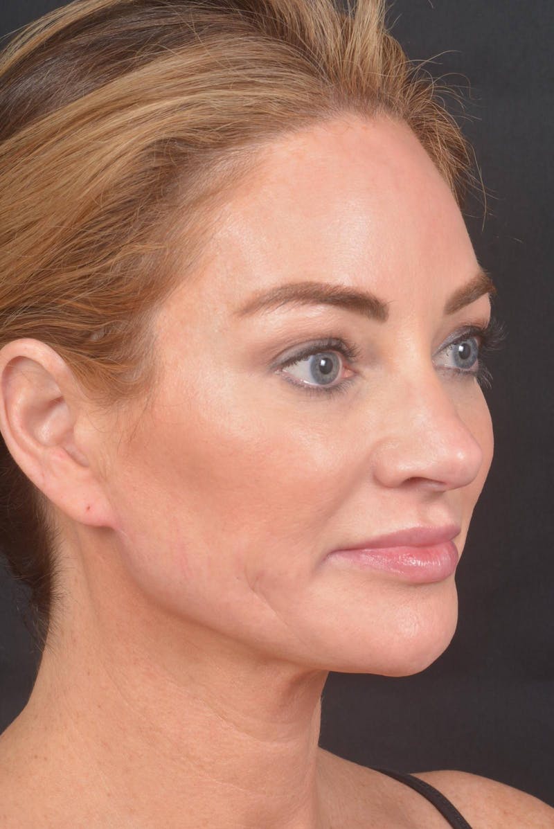 Facelift Before & After Gallery - Patient 418461 - Image 10