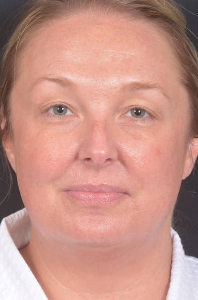 Facelift Before & After Gallery - Patient 212742 - Image 1