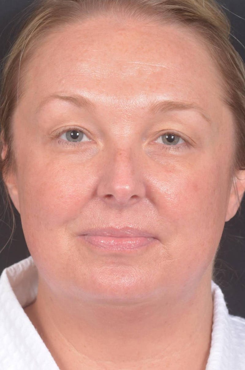 Facelift Before & After Gallery - Patient 212742 - Image 1