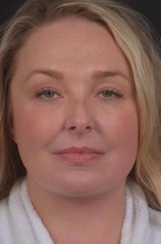 Facelift Before & After Gallery - Patient 212742 - Image 2