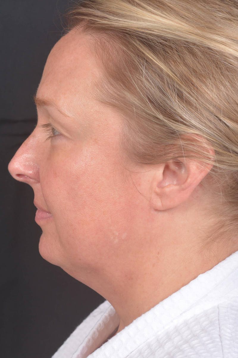 Facelift Before & After Gallery - Patient 212742 - Image 3