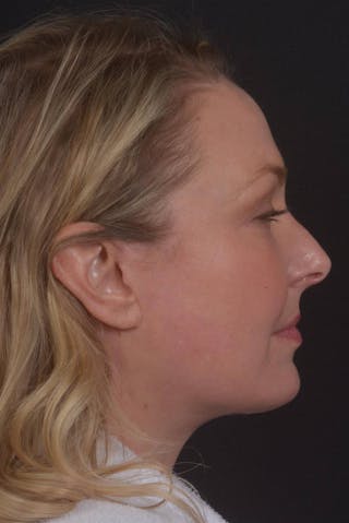 Facelift Before & After Gallery - Patient 212742 - Image 6