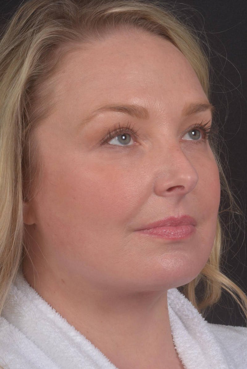 Facelift Before & After Gallery - Patient 212742 - Image 10