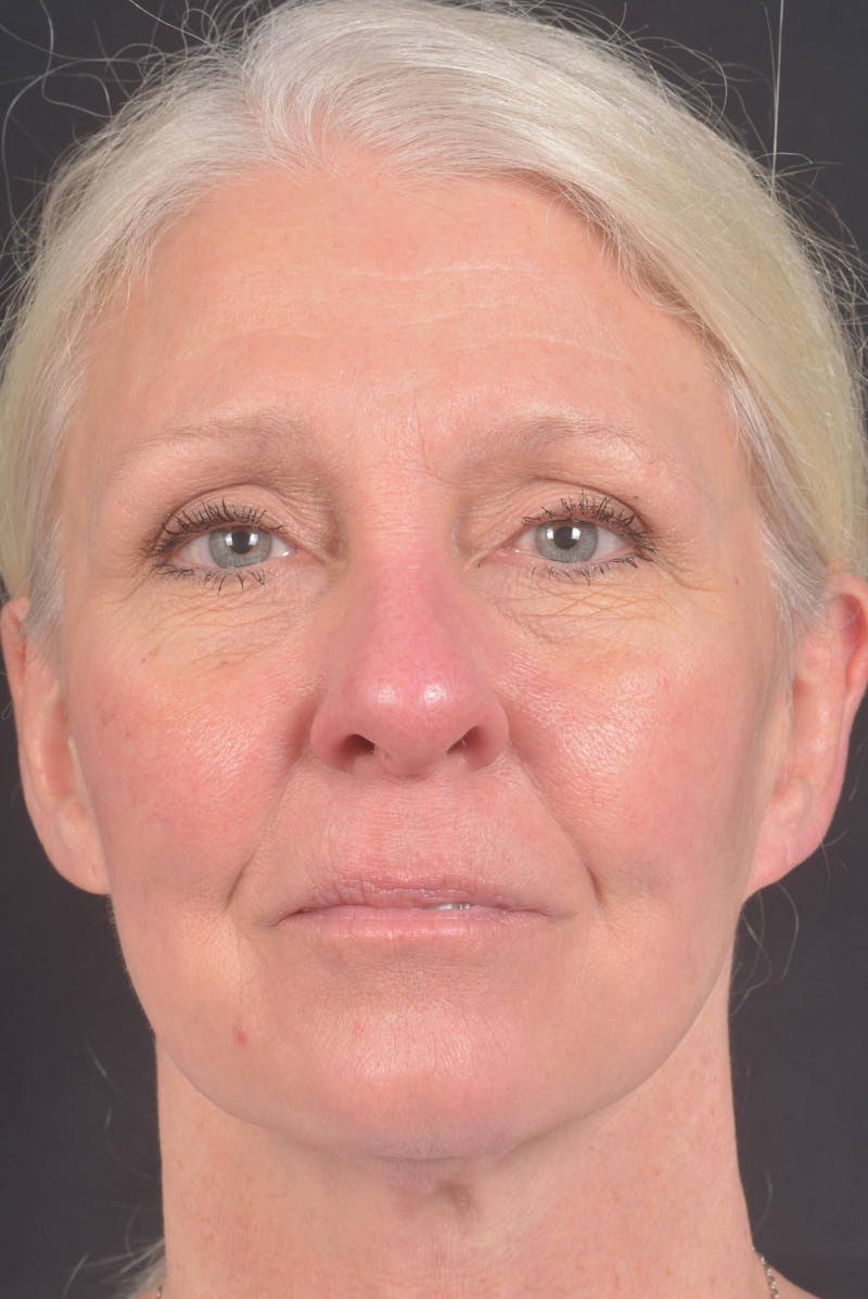 Facelift Before & After Gallery - Patient 217040 - Image 1
