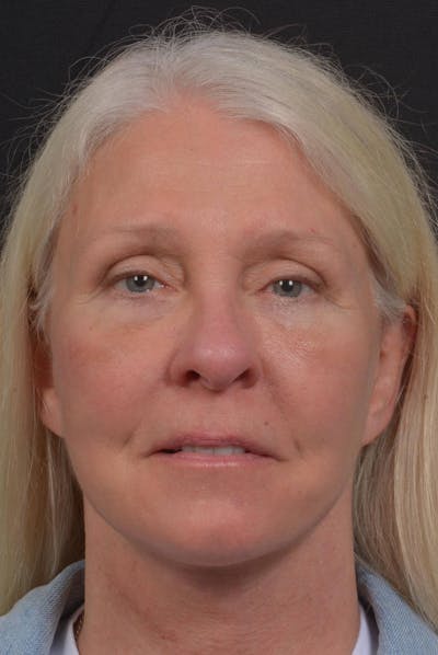Facelift Before & After Gallery - Patient 217040 - Image 2