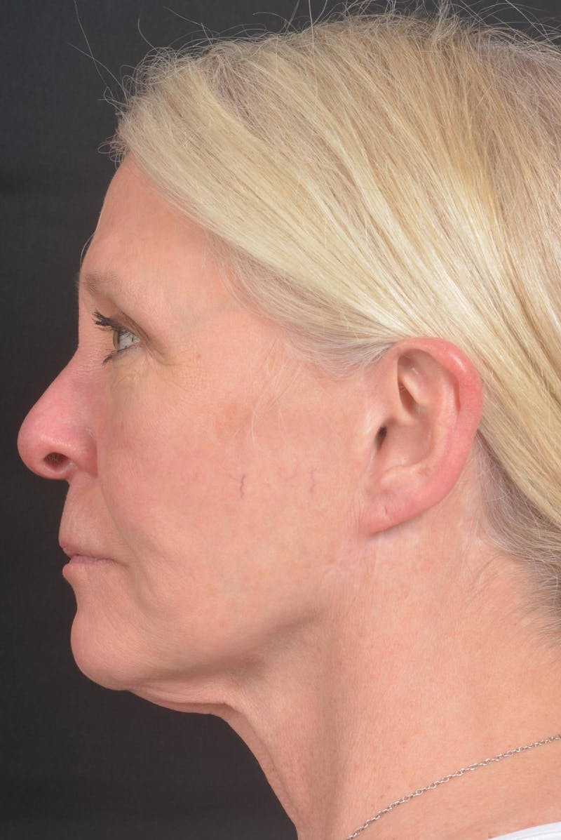 Facelift Before & After Gallery - Patient 217040 - Image 3