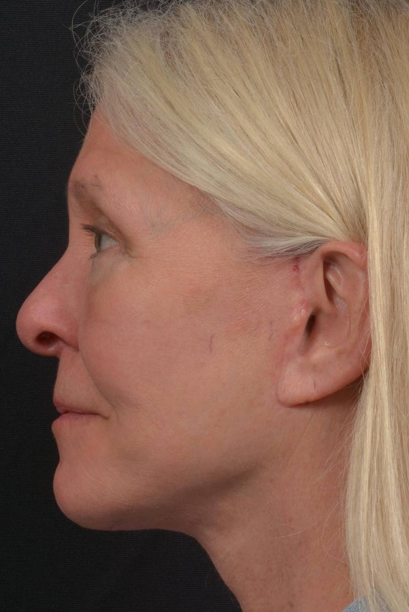 Facelift Before & After Gallery - Patient 217040 - Image 4