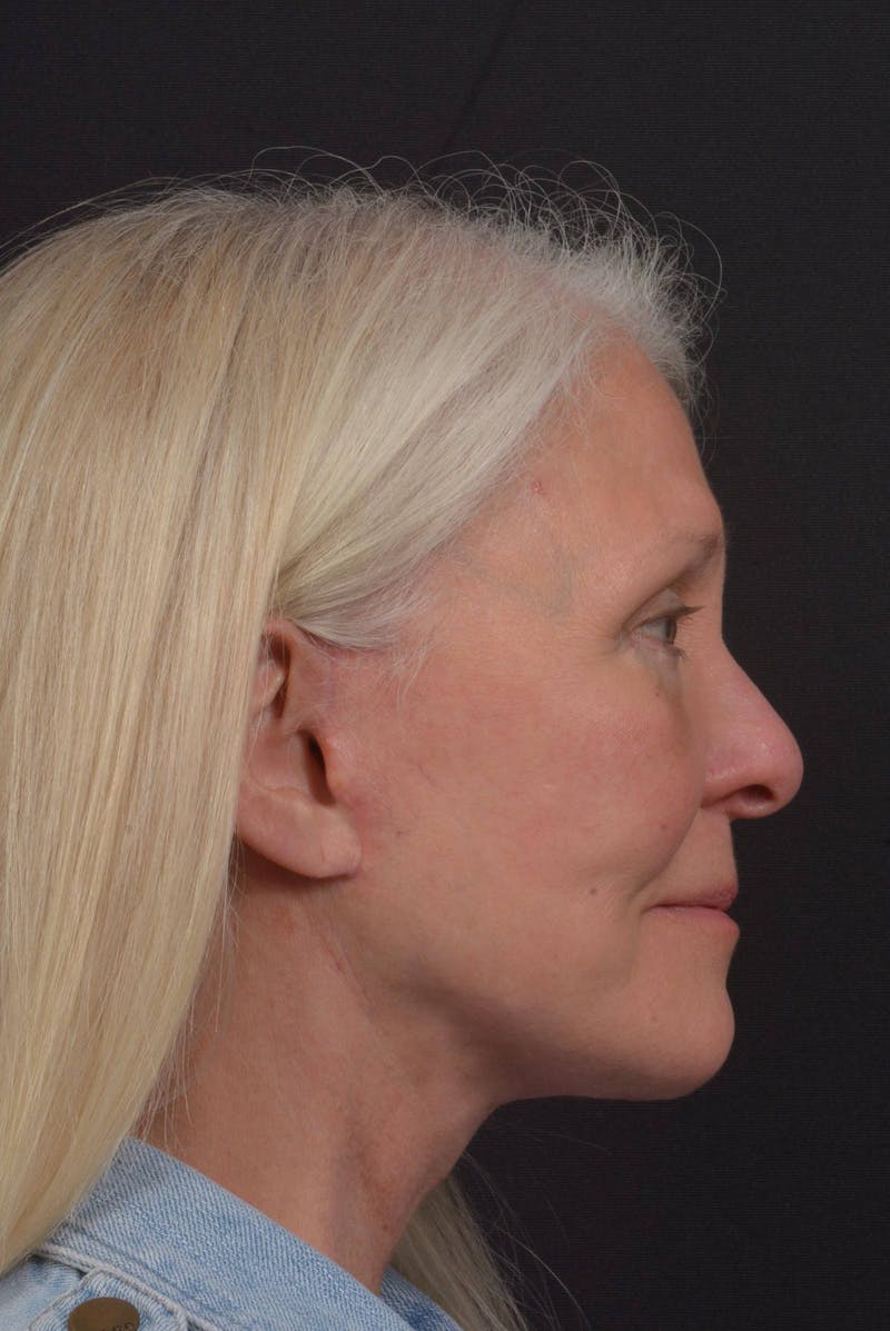 Facelift Before & After Gallery - Patient 217040 - Image 6