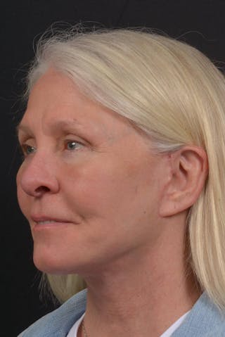 Facelift Before & After Gallery - Patient 217040 - Image 8