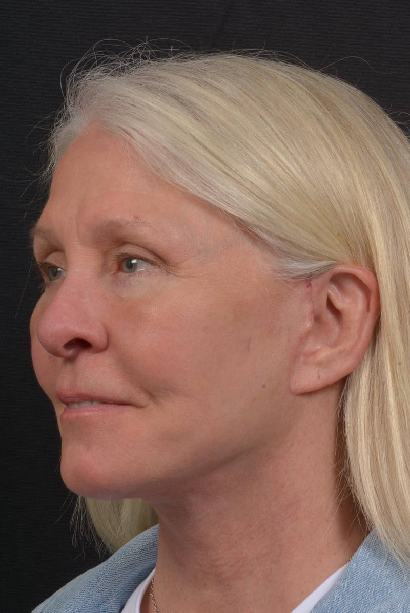 Facelift Before & After Gallery - Patient 217040 - Image 8
