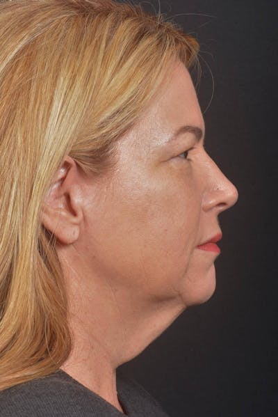 Facelift Before & After Gallery - Patient 827365 - Image 1