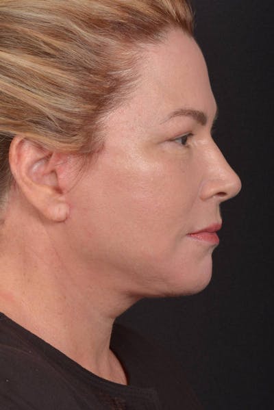 Facelift Before & After Gallery - Patient 827365 - Image 2