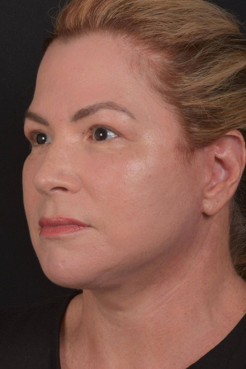Facelift Before & After Gallery - Patient 827365 - Image 6
