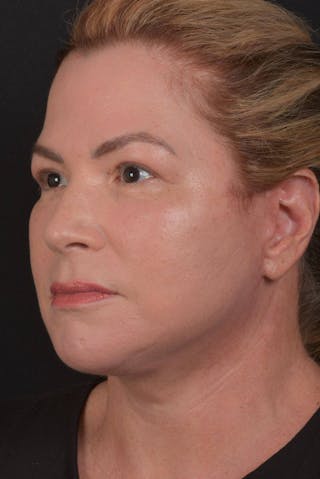 Facelift Before & After Gallery - Patient 827365 - Image 6
