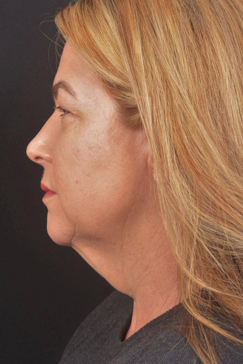 Facelift Before & After Gallery - Patient 827365 - Image 7